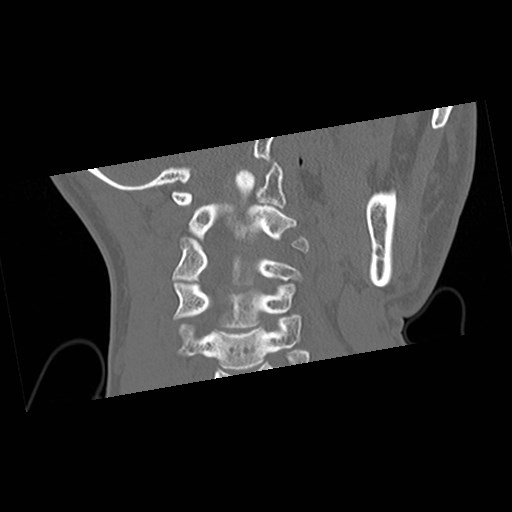 File:C1-C2 "subluxation" - normal cervical anatomy at maximum head rotation (Radiopaedia 42483-45607 Coronal non-contrast 27).jpg