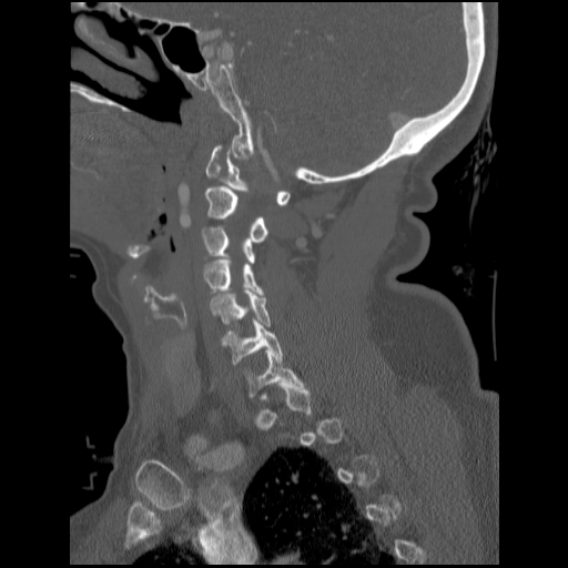 File:C1 anterior arch (plough) fracture - type 1 (Radiopaedia 76181-87720 Sagittal bone window 69).jpg