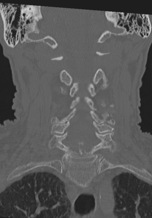 C2 fracture with vertebral artery dissection (Radiopaedia 37378-39199 Coronal bone window 26).png