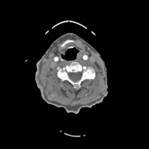 File:C2 fracture with vertebral artery dissection (Radiopaedia 37378-39200 A 127).png