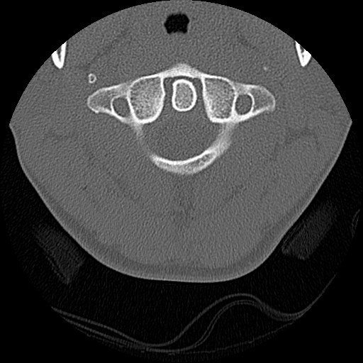 File:C5 facet fracture (Radiopaedia 58374-65499 Axial bone window 17).jpg