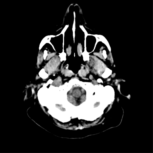 File:CNS Lymphoma (Radiopaedia 44198-47794 Axial non-contrast 5).png