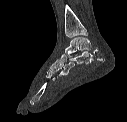 Calcaneal fracture - Sanders type 4 (Radiopaedia 90179-107370 Sagittal bone window 50).jpg