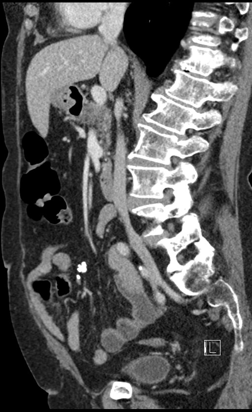 Calcified adrenal glands and Spigelian hernia (Radiopaedia 49741-54988 C 92).jpg