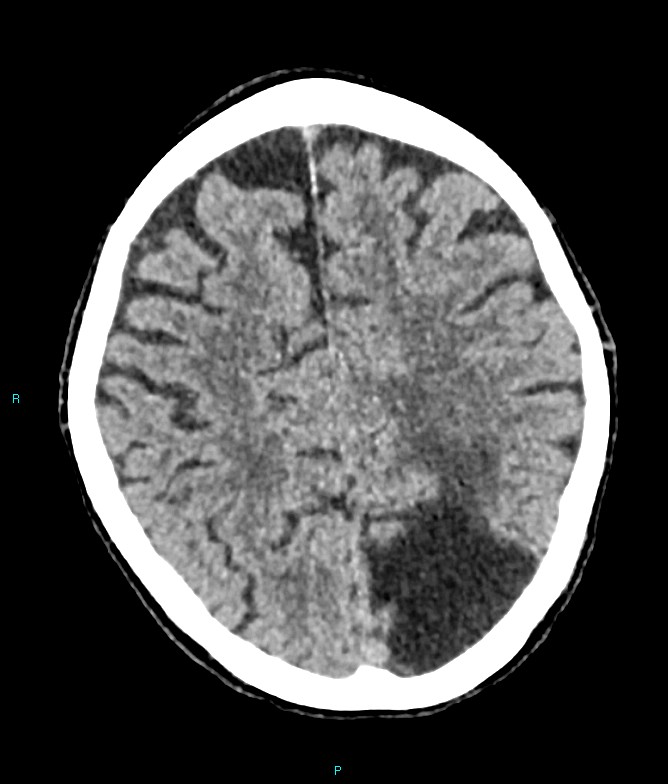 Calcified cerebral emboli from left ventricular thrombus (Radiopaedia 84420-99758 Axial non-contrast 31).jpg