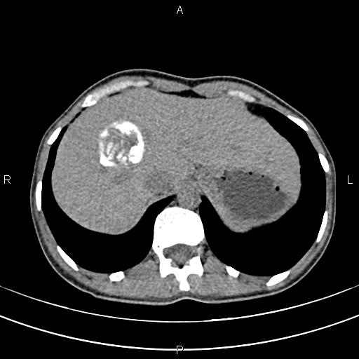 File:Calcified hepatic hydatid cyst (Radiopaedia 83870-99072 Axial non-contrast 28).jpg
