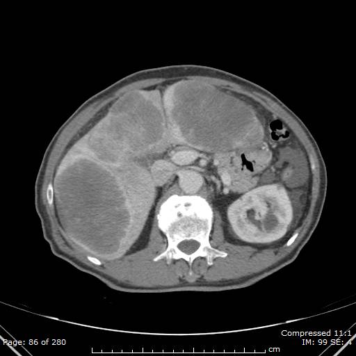 Calcified liver metastases (Radiopaedia 44699-48470 B 31).jpg