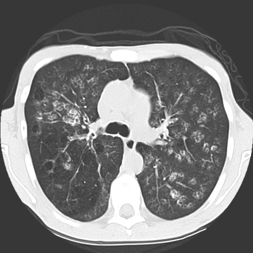 File:Calciphylaxis and metastatic pulmonary calcification (Radiopaedia 10887-11317 Axial lung window 15).jpg