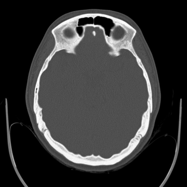 Calvarial osteoma (Radiopaedia 36520-38079 Axial bone window 40).jpg