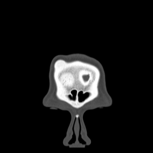 Calvarial osteoma (Radiopaedia 36520-38079 C 7).jpg