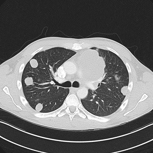 File:Cannonball metastases - testicular choriocarcinoma (Radiopaedia 84510-99891 Axial lung window 40).jpg