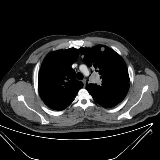 File:Cannonball pulmonary metastases (Radiopaedia 67684-77101 D 79).jpg