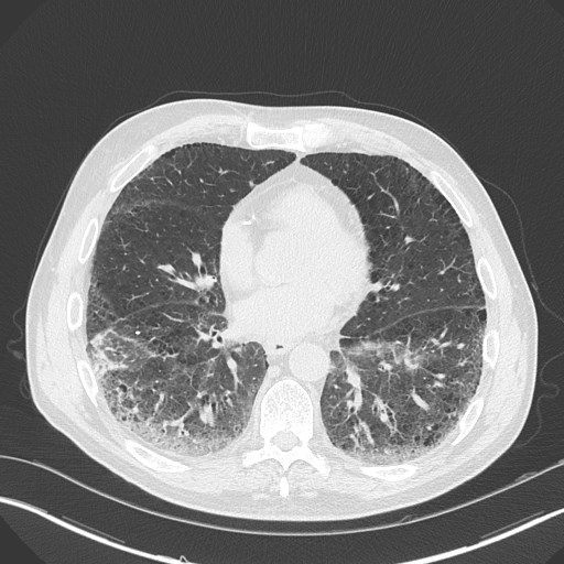 Caplan syndrome (Radiopaedia 56667-63530 Axial lung window 125).jpg