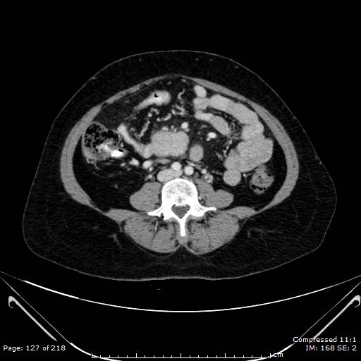 Carcinoid syndrome (Radiopaedia 52706-58626 A 64).jpg