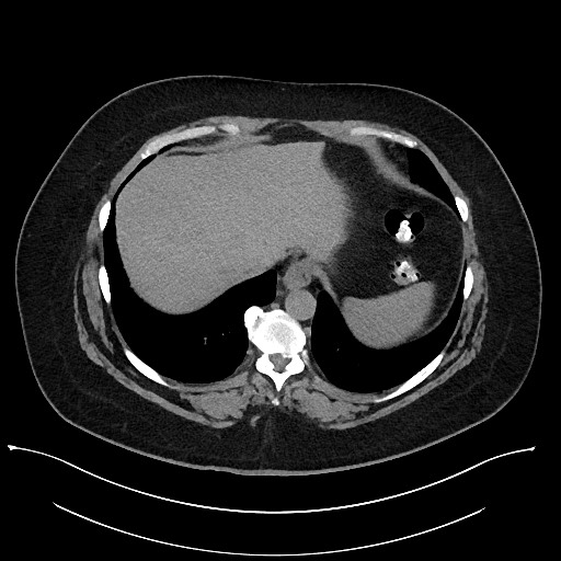Carcinoid tumor - terminal ileum (Radiopaedia 60931-68740 Axial non-contrast 7).jpg