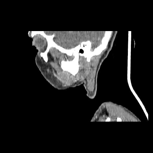 Carcinoma of the maxillary antrum (Radiopaedia 53805-59888 Sagittal C+ delayed 149).jpg