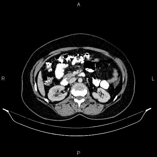 Carcinoma of uterine cervix (Radiopaedia 85861-101700 A 44).jpg