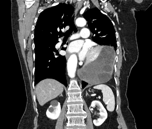 Cardiac hydatid disease (Radiopaedia 64684-73611 Axial reconstruction 33).jpg