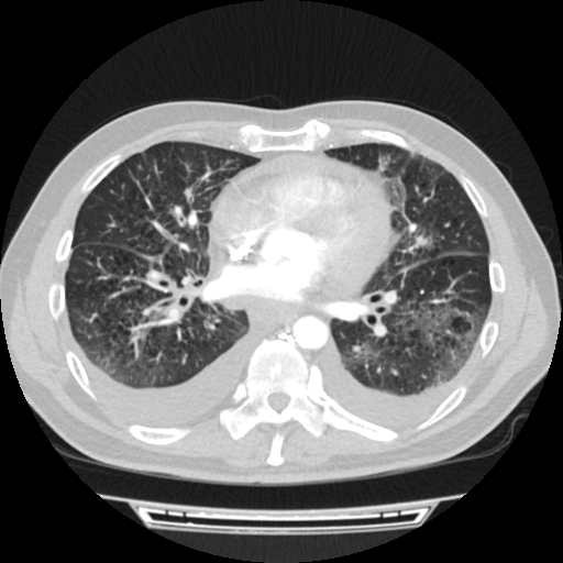 Cardiac tamponade (Radiopaedia 78607-91368 Axial lung window 51).jpg