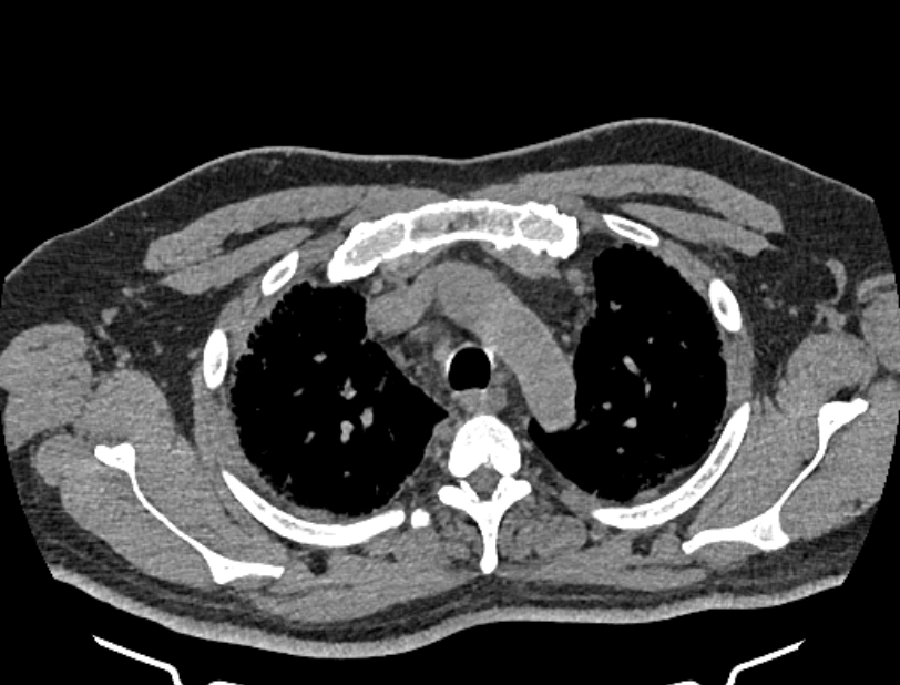 Cardiogenic pulmonary edema (Radiopaedia 68180-77678 Axial non-contrast 9).jpg