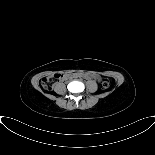 Caroli disease with medullary sponge kidney (Radiopaedia 82622-96804 Axial non-contrast 47).jpg
