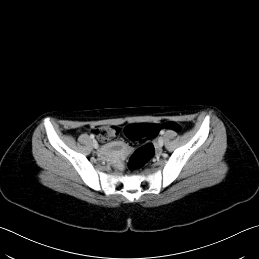 Caroli disease with medullary sponge kidney (Radiopaedia 82622-96804 C 62).jpg
