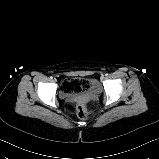 Caroli disease with medullary sponge kidney (Radiopaedia 82622-96804 C 71).jpg