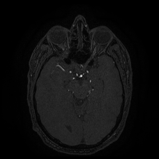 File:Carotid arterial dissection with acute cerebral infarction (Radiopaedia 26636-26784 MRA 98).jpg