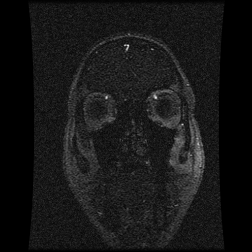 Carotid arterial dissection with acute cerebral infarction (Radiopaedia 26636-26784 MRV 135).jpg