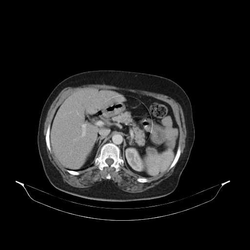File:Carotid body tumor (Radiopaedia 21021-20948 B 65).jpg
