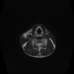 File:Carotid body tumor (Radiopaedia 30208-30823 Axial T2 5).jpg