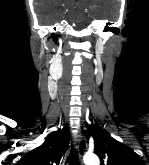 File:Carotid body tumor (Radiopaedia 39845-42300 C 48).jpg