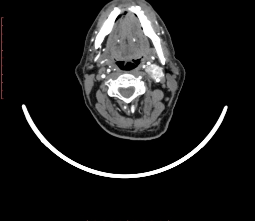 Carotid body tumor (Radiopaedia 66785-76116 B 26).jpg