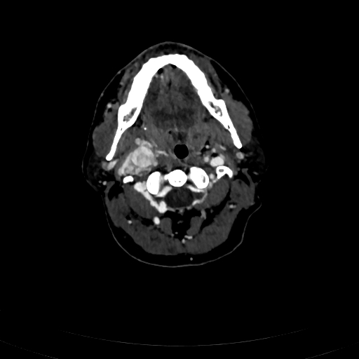 Carotid body tumor (Radiopaedia 83615-98727 D 43).jpg