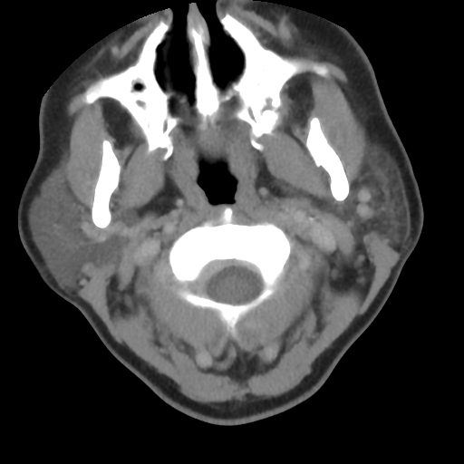 Carotid body tumor (paraganglioma) (Radiopaedia 38586-40729 A 46).jpg