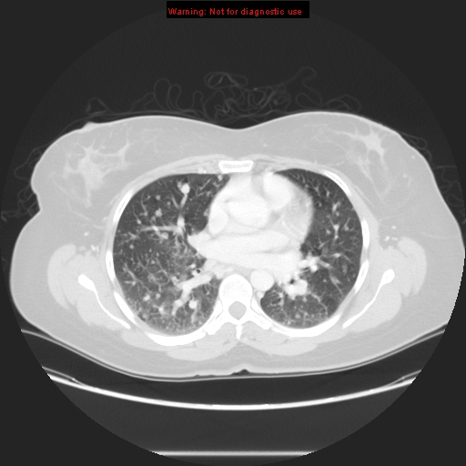 Carotid body tumor with lung metastases (Radiopaedia 9301-48390 Axial lung window 38).jpg