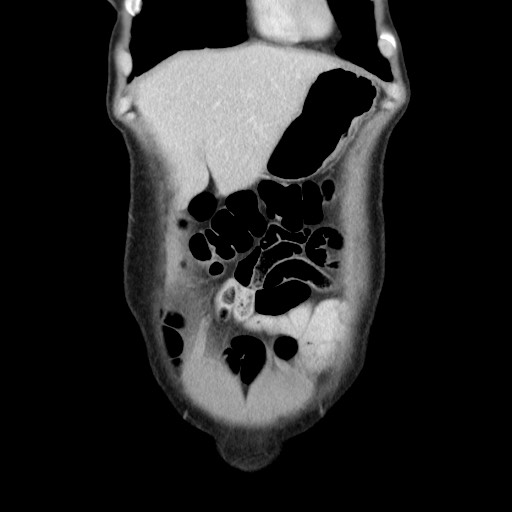 Castleman disease with fibrous pseudotumor in the abdomen (Radiopaedia 77296-89373 B 18).jpg