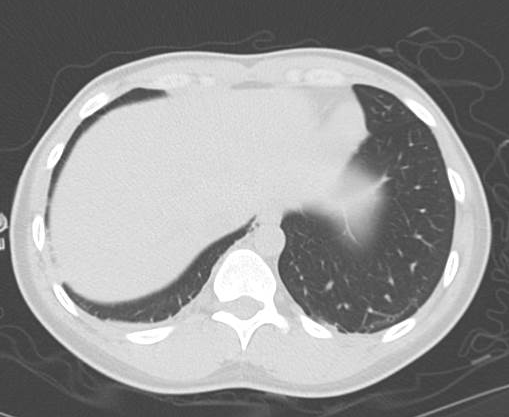 File:Catamenial pneumothorax (Radiopaedia 54382-60600 Axial 70).png