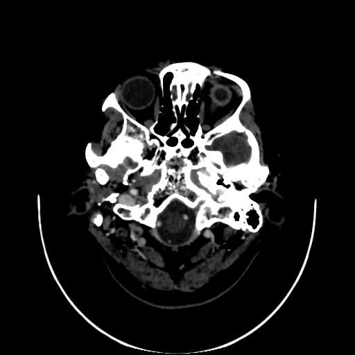 Cavernoma with developmental venous anomaly (Radiopaedia 22470-22506 C 5).jpg