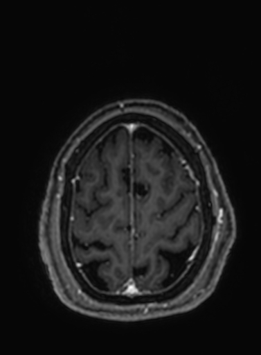 Cavernous hemangioma of the cerebellar falx (Radiopaedia 73025-83724 Axial T1 C+ 58).jpg