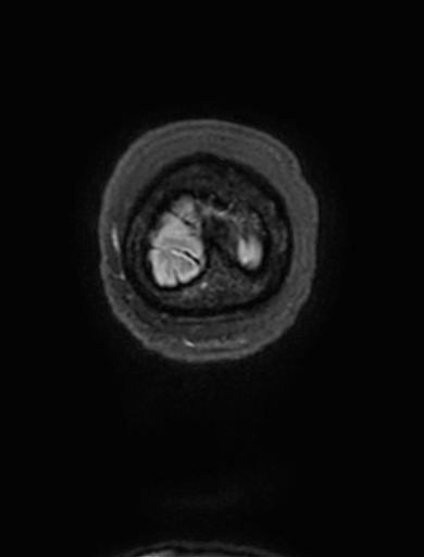 Cavernous hemangioma of the cerebellar falx (Radiopaedia 73025-83724 Coronal FLAIR 353).jpg
