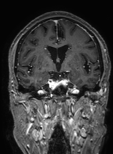 Cavernous hemangioma of the cerebellar falx (Radiopaedia 73025-83724 Coronal T1 C+ 171).jpg