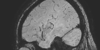 Cavernous hemangioma of the cerebellar falx (Radiopaedia 73025-83724 Sagittal BOLD 164).jpg