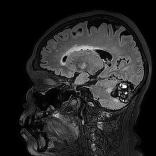 Cavernous hemangioma of the cerebellar falx (Radiopaedia 73025-83724 Sagittal FLAIR 138).jpg