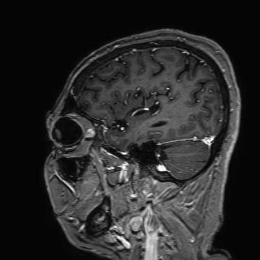 Cavernous hemangioma of the cerebellar falx (Radiopaedia 73025-83724 Sagittal T1 C+ 49).jpg