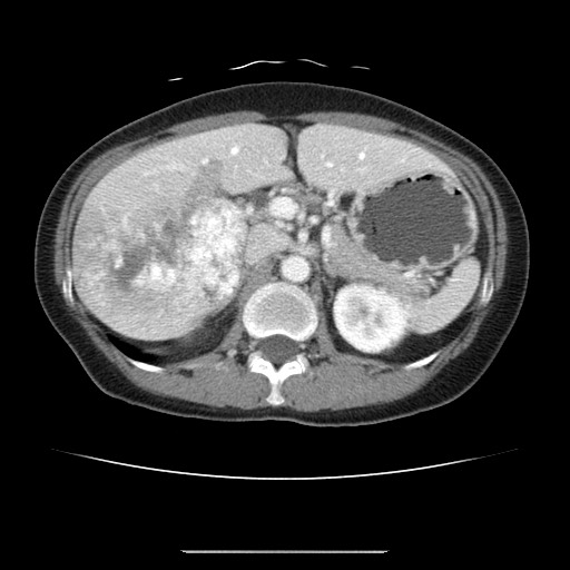 Cavernous hepatic hemangioma (Radiopaedia 75441-86667 B 37).jpg