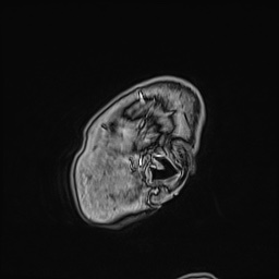 Cavernous sinus meningioma (Radiopaedia 63682-72367 Sagittal T1 C+ 19).jpg
