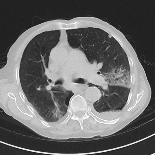 Cavitating pneumonia - lingular segments (Radiopaedia 34386-35678 Axial lung window 28).png