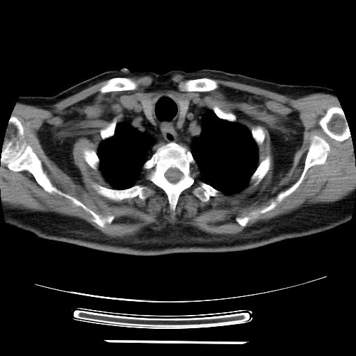 File:Cavitating pulmonary metastases (Radiopaedia 89545-106544 Axial non-contrast 5).jpg