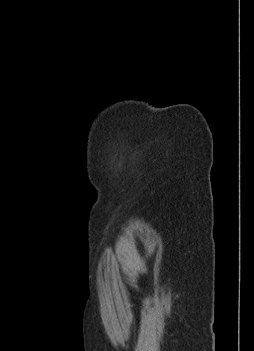 Cecal adenocarcinoma - surgical scar recurrence (Radiopaedia 79988-93264 D 1).jpg